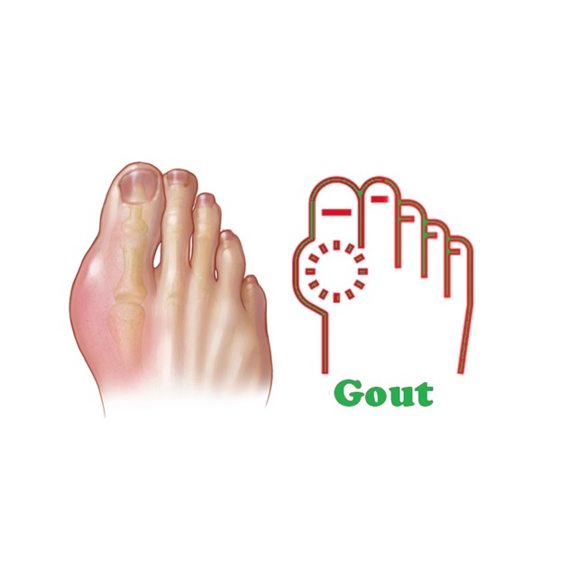 Uric Acid and Gout