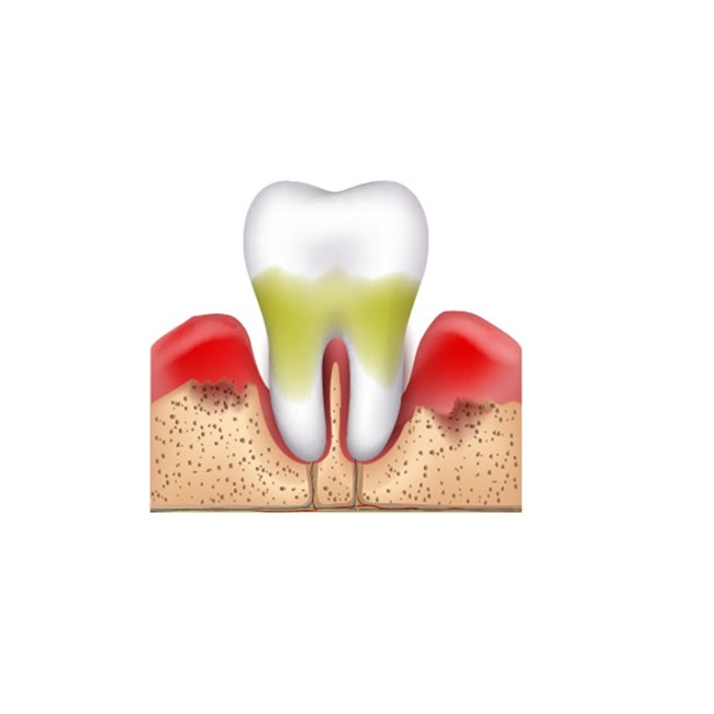Periodontitis and Bleeding Gum