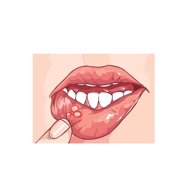 Aphthae and Mouth Ulcers